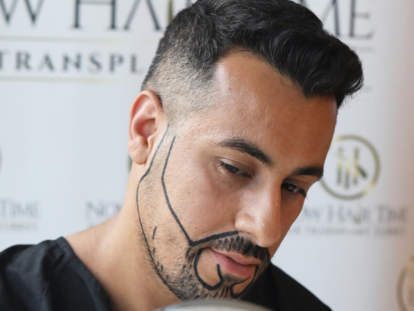 Mustache Transplant