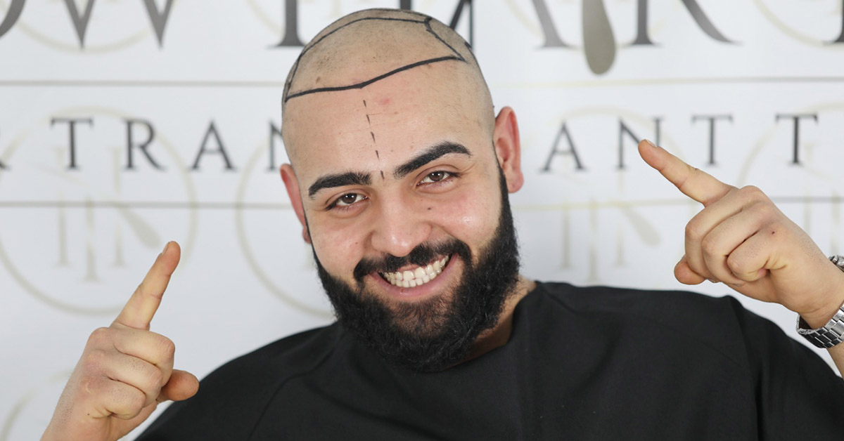 Which Criteria Should a Good Hair Transplant Technique Have?